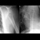 Dislocation of shoulder, anterior luxation: X-ray - Plain radiograph